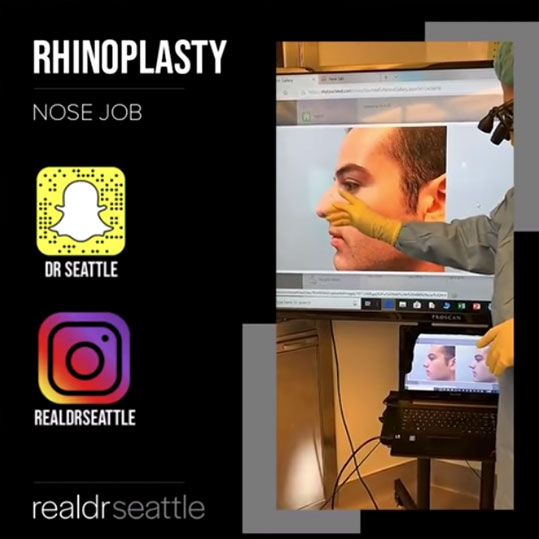Nose Job Surgery (Rhinoplasty) by Top Seattle Plastic Surgeon