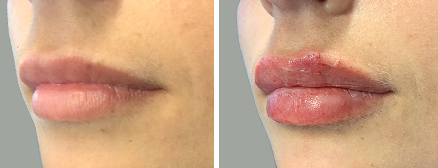 Lip Filler Before After 02