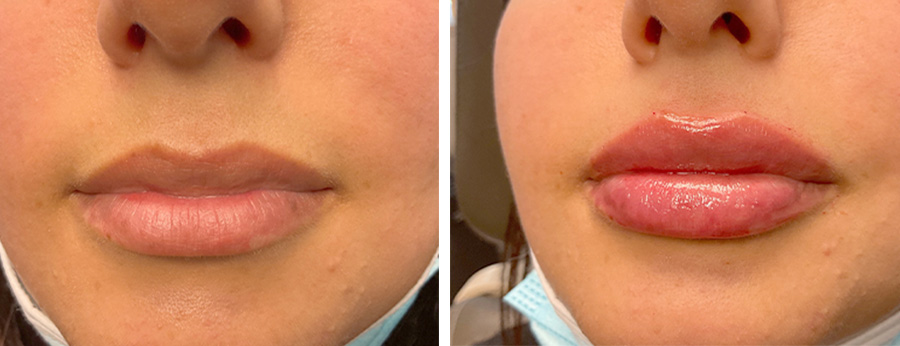 Lip Filler Before After