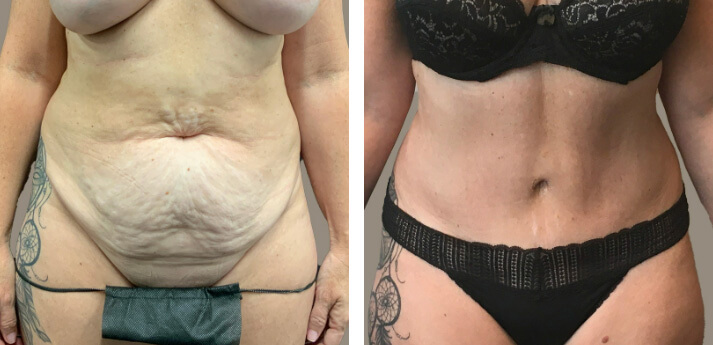 Mommy Makeover Bellevue 03