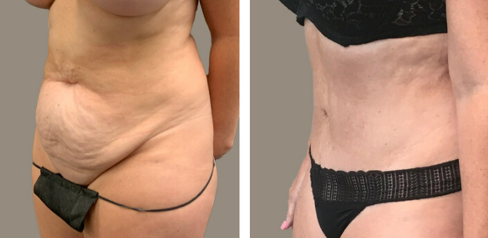 Mommy Makeover Bellevue 04