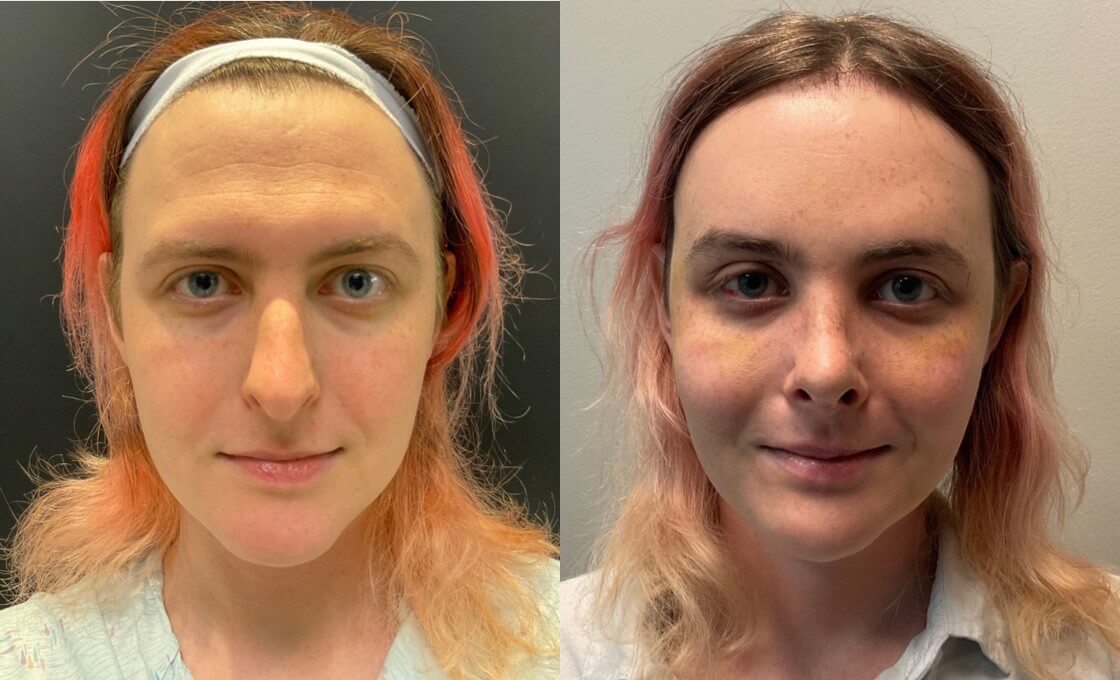 Facial Feminization Before & After