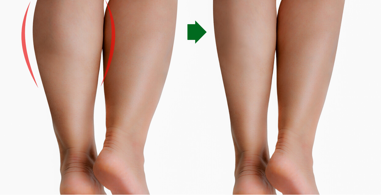 Benefits Of Botox For Calves