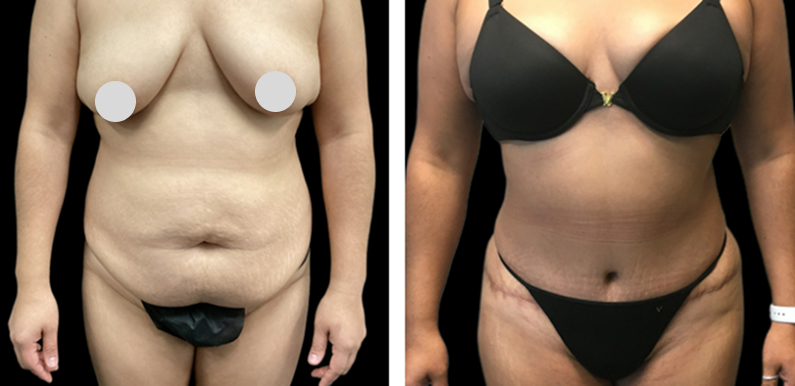 Extended Tummy Tuck Before After 01