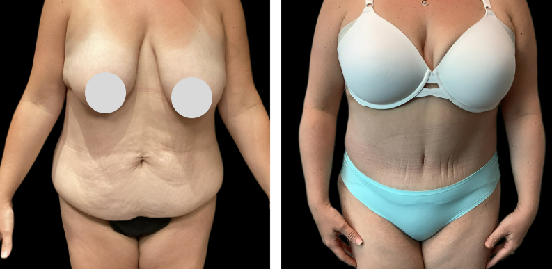 Extended Tummy Tuck Before After 02