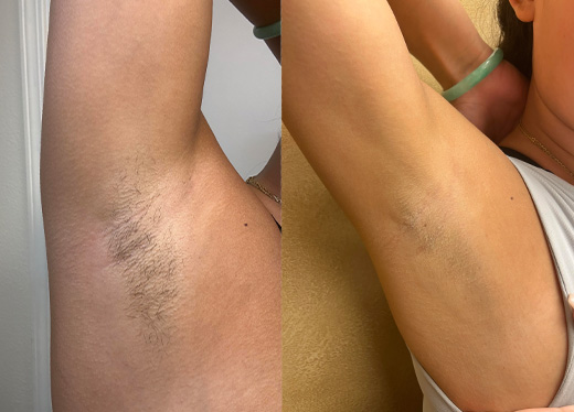 Laser Hair Removal Before After Underarm