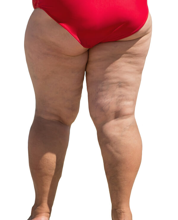 Lipedema Liposuction Seattle 2