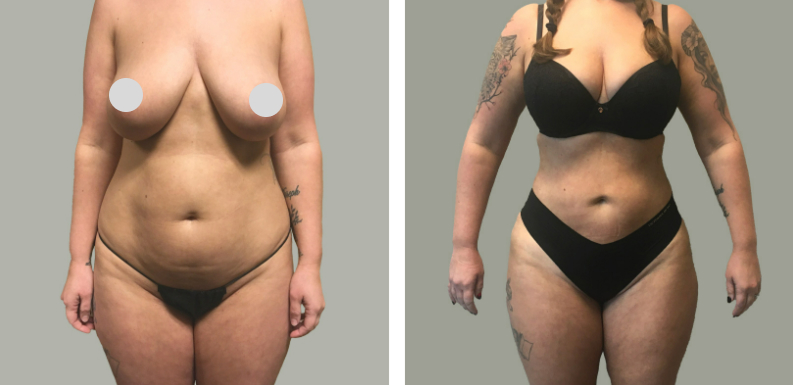 Lipo 360 Before After 01