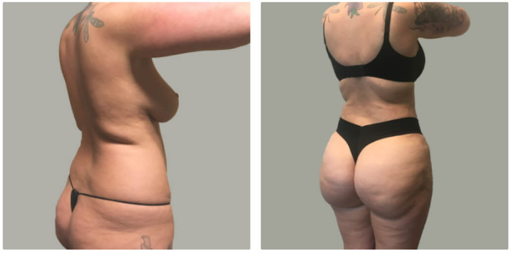Lipo 360 With BBL Before & After Photo