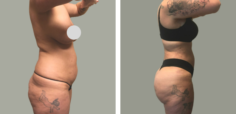 Lipo 360 W Bbl Before After 01