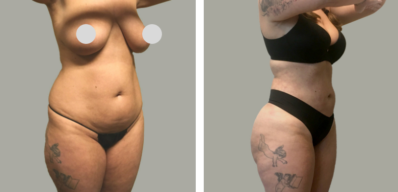 Lipo 360 W Bbl Before After 02