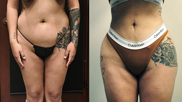 Liposuction 360 BBL WITH Post Op Results Video Poster