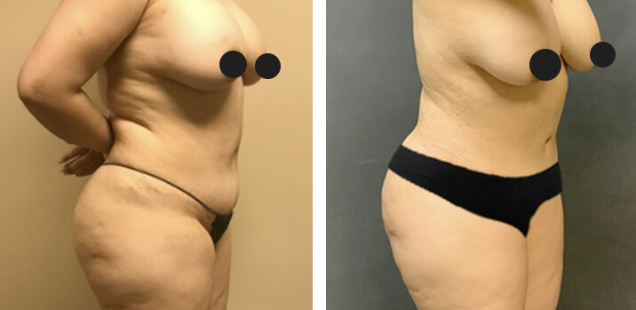 Mommy Makeover Bbl 04