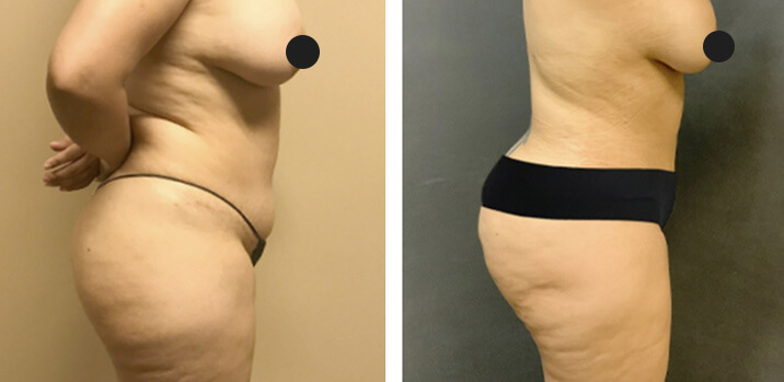 Mommy Makeover Bbl 05