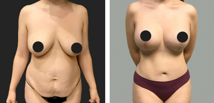 Mommy Makeover Breast0lift 02