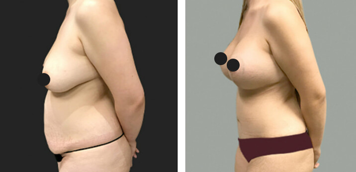 Mommy Makeover Breast0lift 03