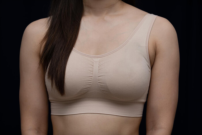 Mommy Makeover Revision