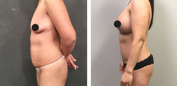 Mommy Makeover Tummy Tuck 02