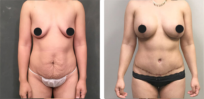 Mommy Makeover Tummy Tuck 03