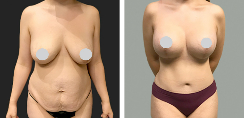 Mommy Make Over Before After 02