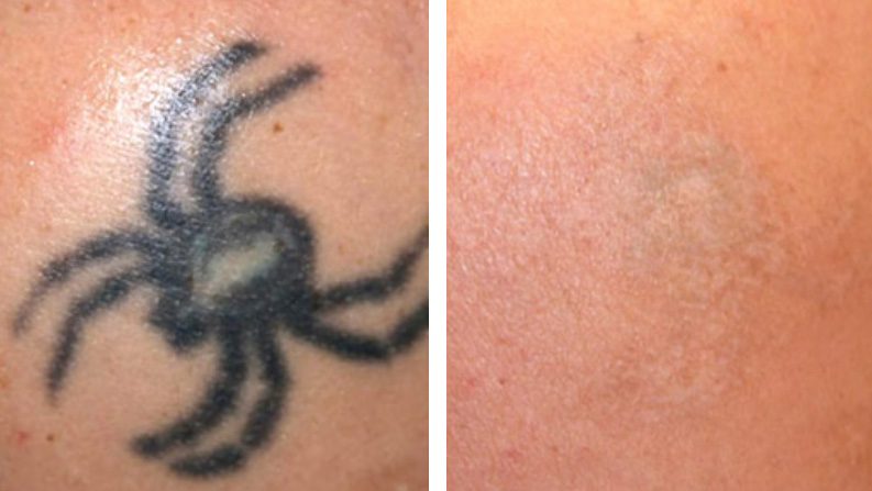 Tatoo Removal Before After 01