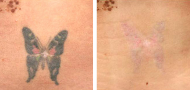 Tatoo Removal Before After 02