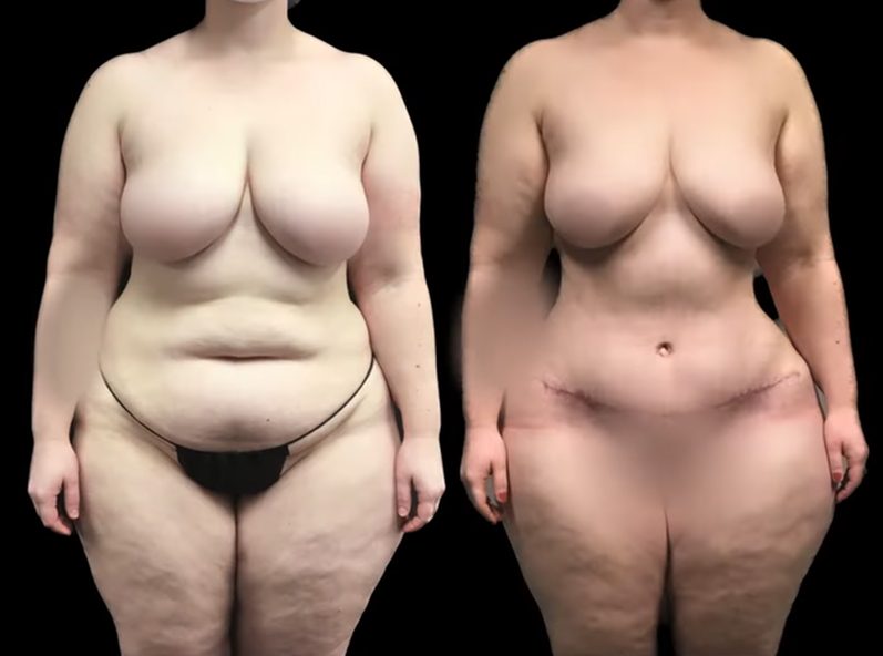 Tummy Tuck After Weight Loss Before After