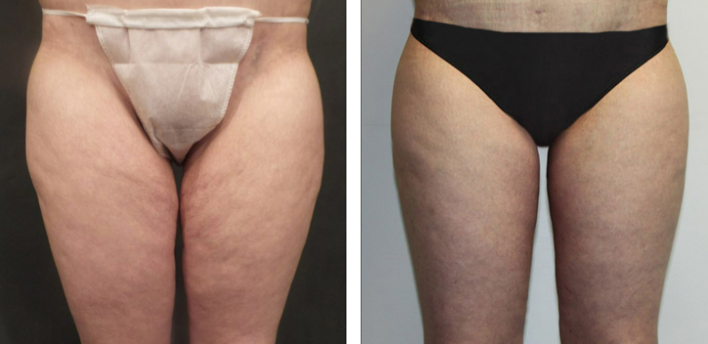 Thigh Lift Before After 01