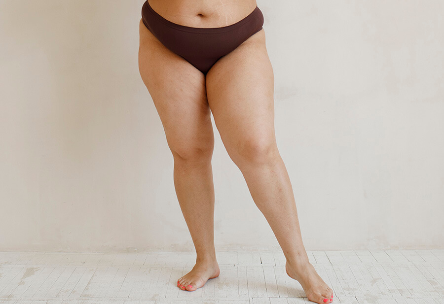 Vertical Thigh Lift 03