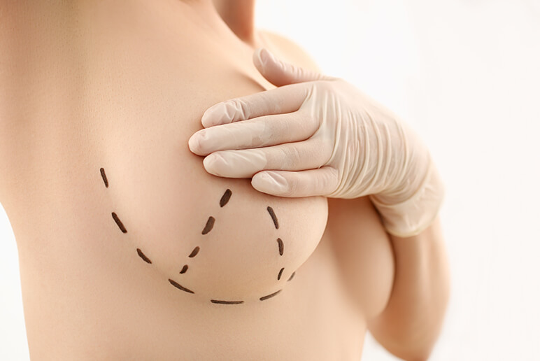 Breast Lift Seattle