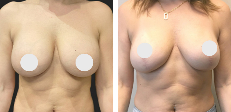 Breast Augmentation Revision Before After 01