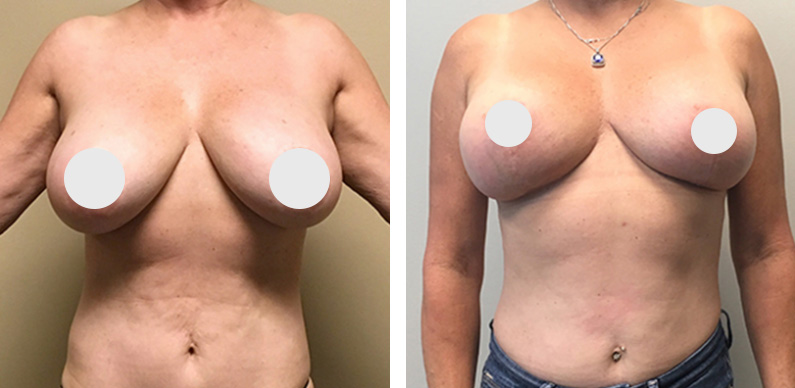 Breast Implant Removal Before After 01