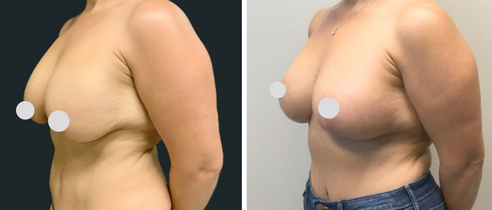 Before after brease lift with implant removal