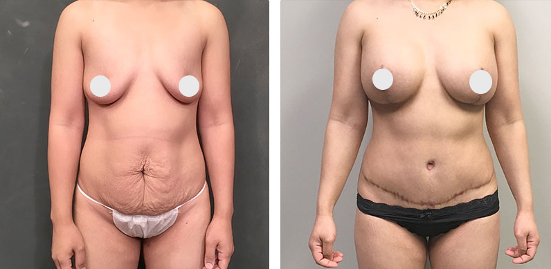 Breast Lift Seattle