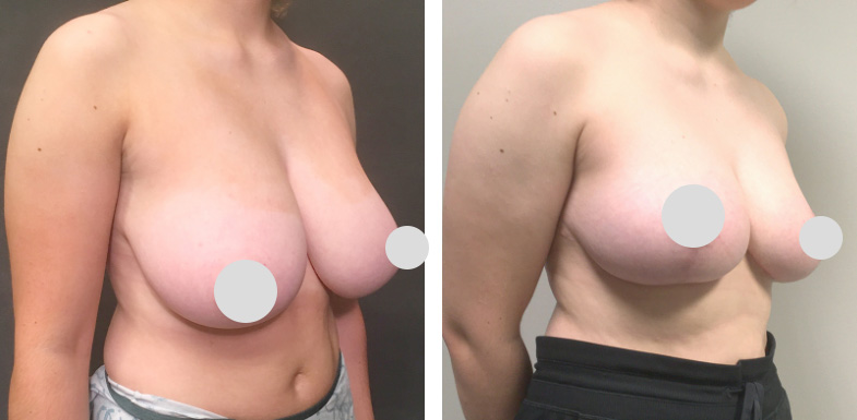 Breast Reduction Before After 02