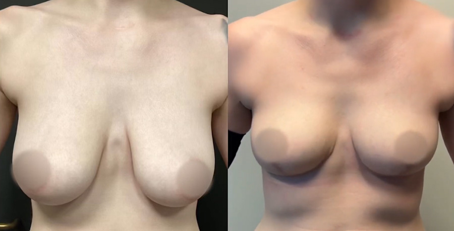 Breast Reduction Before After