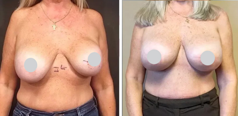 Repair Capsular Contracture Before After 02