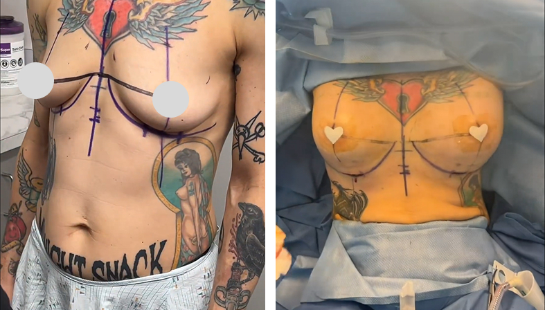 Dual Plane Breast Augmentation Before After 01