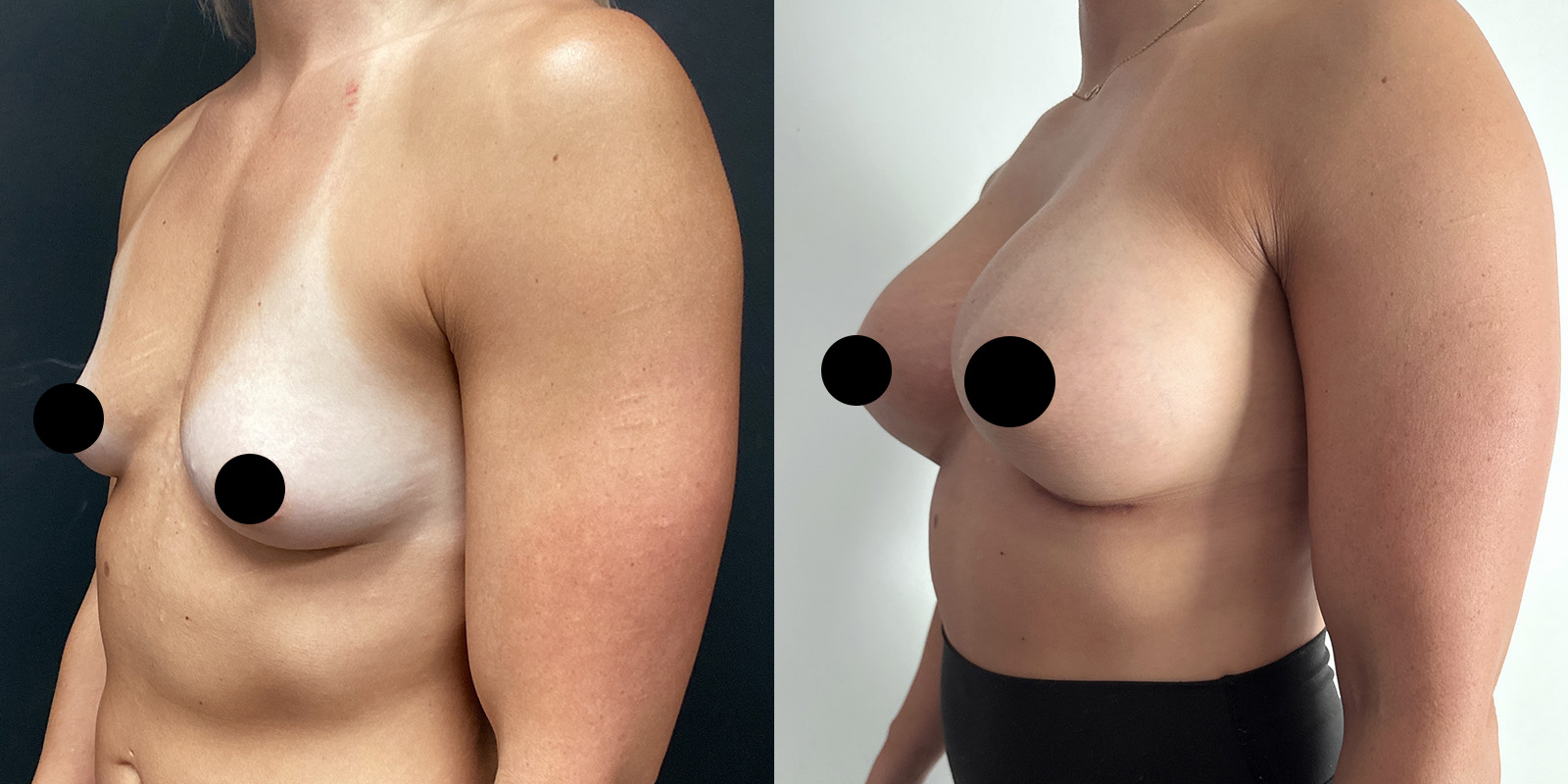 Dual Plane Breat Augmentation Before After Case 02