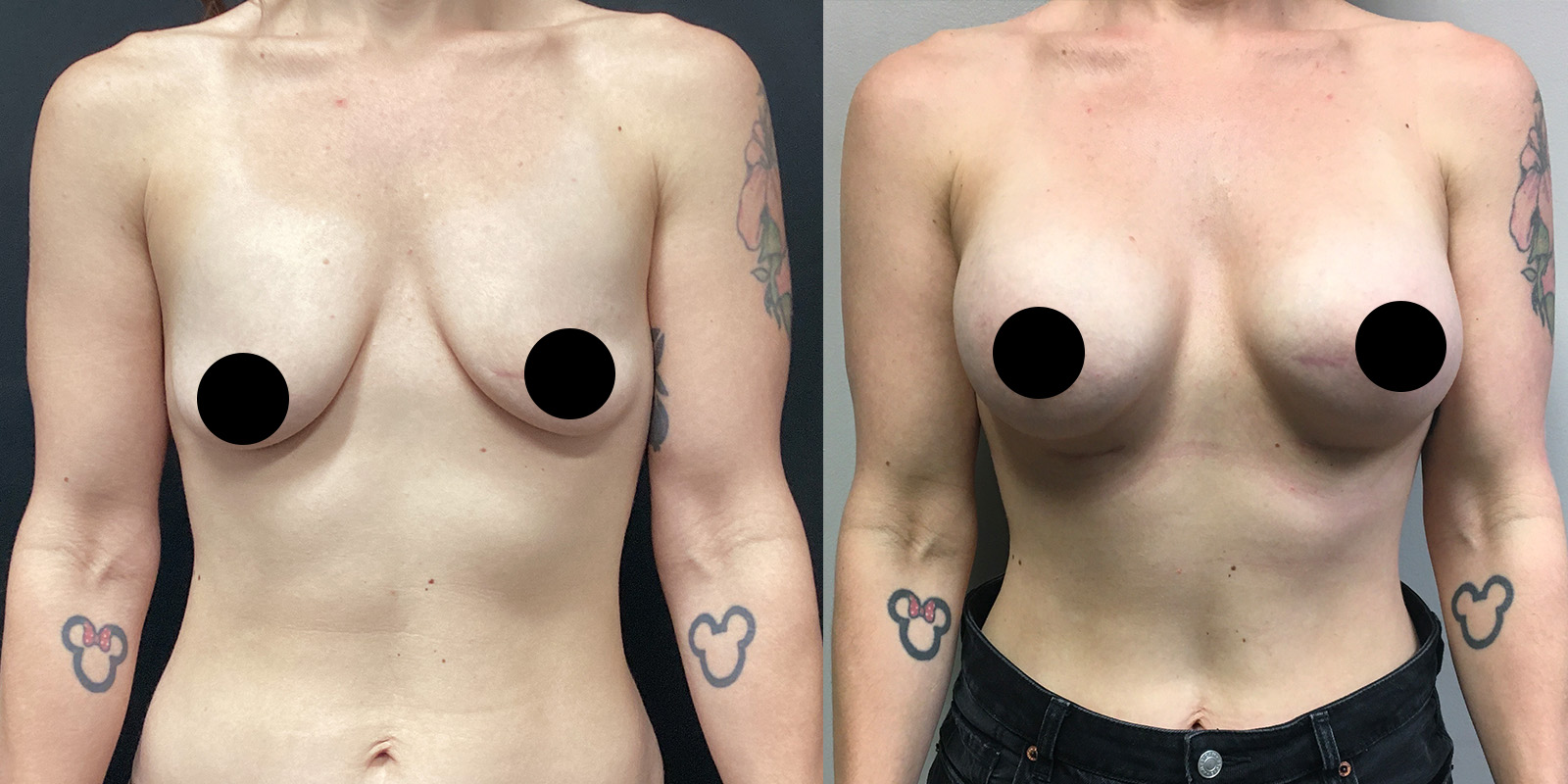 Dual Plane Breat Augmentation Before After Case 03