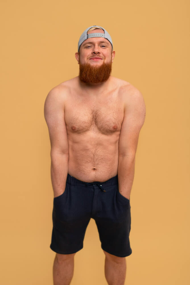 Gynecomastia Revision Allure 001