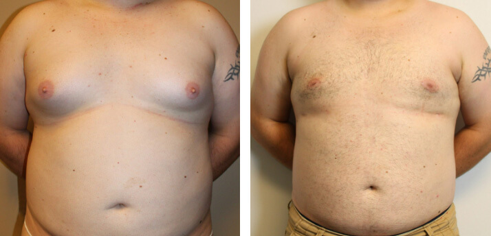 Gynecomastia 02