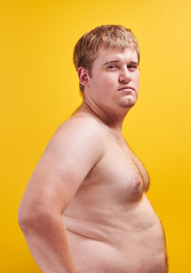 Teen Gynecomastia 03