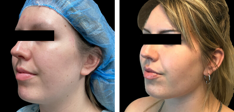 Lower Face Contouring 02