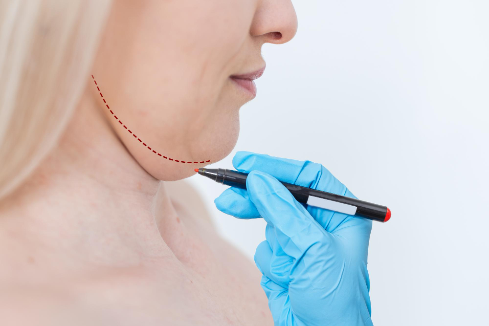 Modal showing Chin Liposuction