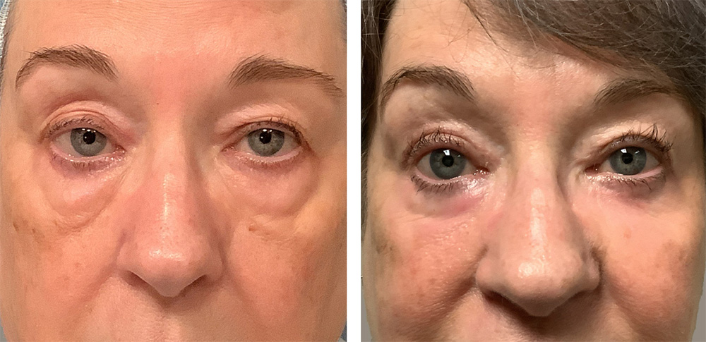 Eyelid Surgery Seattle
