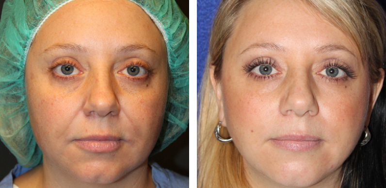 Facial Fat Transfer Before After 01