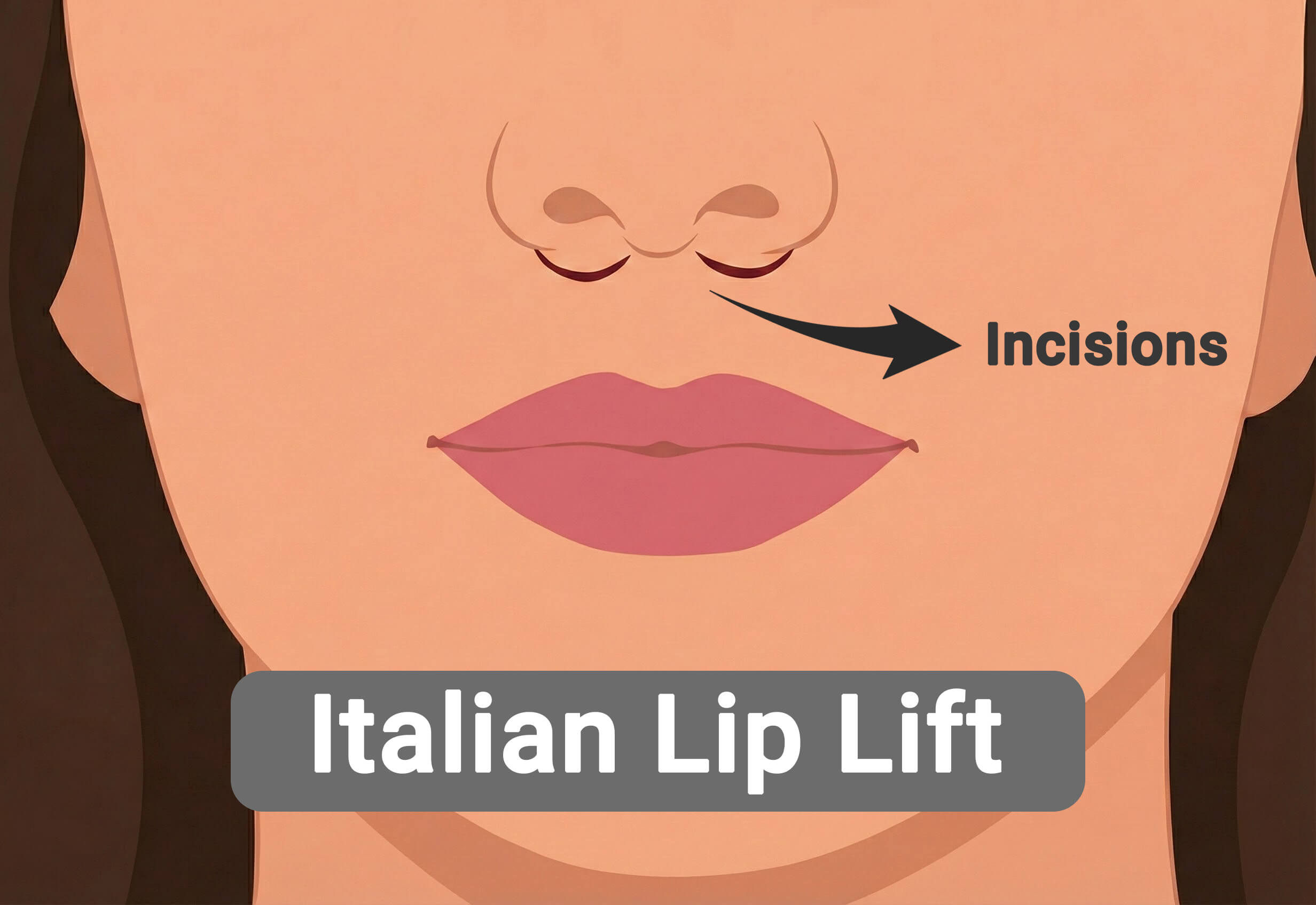 What Is an Italian Lip Lift?