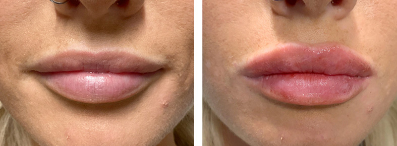 Lip Filler 04