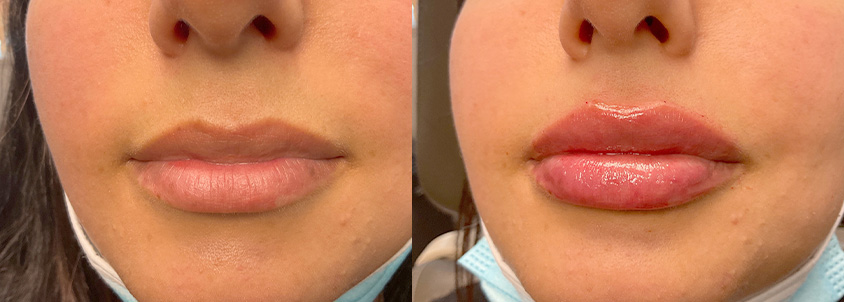 Lip Filler Allure 05